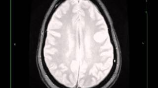 Granulomatous Inflammation Possible IgG4 Disease [upl. by Grier]