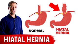 What Should I Eat with a Hiatal Hernia Acid Reflux [upl. by Chandra158]