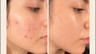 Vanish your acne marks with Demelan cream 41100 [upl. by Nirrac]