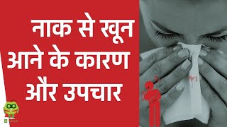 नाक से खून आने के कारण और उपचार  Epistaxis In Hindi  Healthyho [upl. by Whipple]