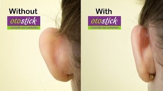 New Otostick Cosmetic Ear Correctors  A solution for prominent ears [upl. by Alva]