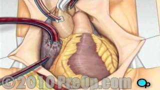 Coronary Artery Bypass CABG Surgery [upl. by Zabrina]