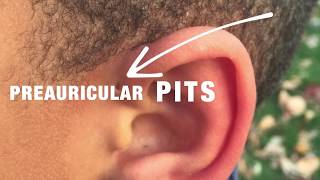 Preauricular Pits with Dr David Mener [upl. by Mannos]