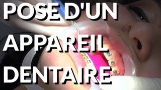 Pose dun Appareil Dentaire  Appareildentaireinfo [upl. by Byrd]