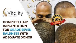 Complete hair implantation for grade seven baldness with adequate donor [upl. by Kamila759]