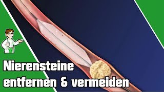 Nierensteine entfernen und vermeiden  SO geht es 👨‍⚕️ [upl. by Helmer]