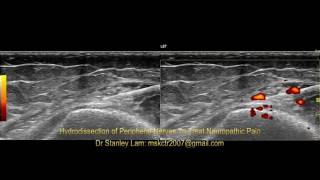 Ultrasound Guided Hydrodissection of Obturator Nerve and Saphenous Nerve at the Adductor Tubercle [upl. by Meekar980]