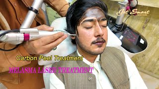 melasma laser treatment Carbon Peel Laser  4k video [upl. by Tzong]