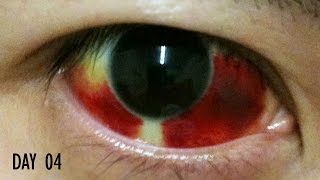 27 Days Healing Time Lapse Broken Blood Vessel in Eye Subconjunctival Hemorrhage [upl. by Spiegleman]