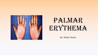 Palmar erythema causes and pathophysiology [upl. by Hilaria598]