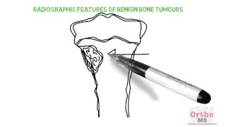 Radiographic features  Benign bone tumours [upl. by Ruth]