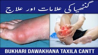 Ganthiya Ka Ilaj  Arthritis Treatment UrduHindi  Best Natural Treatment [upl. by Nonek635]