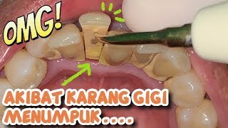 Untuk Kamu yang Belum Pernah Scaling Jangan Sampai Seperti Ini  Dokter Gigi Tri Putra [upl. by Matthei507]