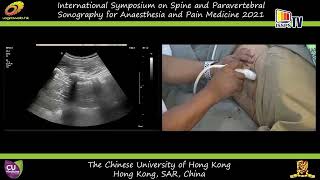 Ultrasound Imaging of the Lumbar Spine Sonoanatomy Demonstration in Volunteers Dr MK Karmakar [upl. by Mcconnell910]