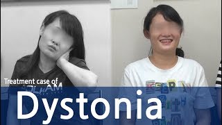 Cervical Dystonia Dystonia Spasmodic Torticollis  사경증 치료사례  근긴장이상증 [upl. by Amliw]