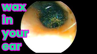 asmr ear cleaning  wax in your ear  Ear health  ear piercing cleaning how to unclog your ear [upl. by Adiasteb858]