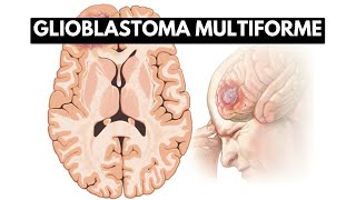 Inside Glioblastoma Multiforme A Journey into the Deadliest Brain Tumor [upl. by Chemesh188]