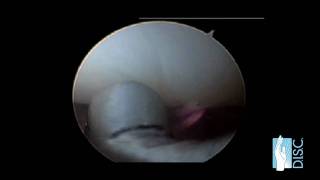 Wrist Arthroscopy Surgery [upl. by Balf]