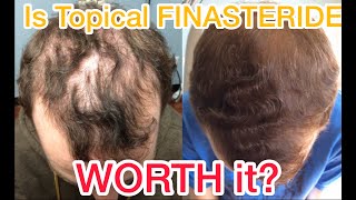 Amazing results from topical Finasteride for hair loss and thinning hair [upl. by Begga564]