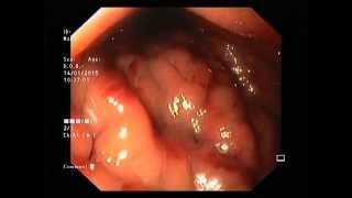 severe portal hypertension gastropathy [upl. by Jaime]