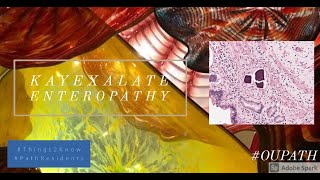 Kayexalate enteropathy [upl. by Noah243]