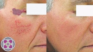 Laser Vein Removal Broken Capillaries and Spider Veins [upl. by Erreid]