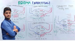 Interstitial Edema Pathology  Edema part 3 [upl. by Abagael877]