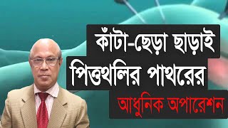 কাঁটাছেড়া ছাড়াই পিত্তথলির পাথরের অপারেশন।laproscopic operation। LGSH [upl. by Anaitat]