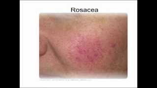 Revitol Rosacea Cream  Buy From Original Vendor Here [upl. by Tyrone]