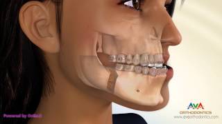 Surgical Orthodontic Treatment for Underbite or Crossbite  BSSO Mandibular Setback [upl. by Adnelg691]