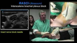 Ultrasound guided interscalene brachial plexus block [upl. by Elbart]