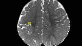 Perinatal hypoxic injuty with white matter paucity and gliosis Ulegyria [upl. by Suhploda]