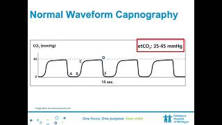 Waveform Capnography Implementation [upl. by Wolcott468]