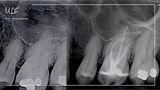 Endodontic treatment workflow  Part 2  Irrigation Obturation and Core Build Up [upl. by Idorb]