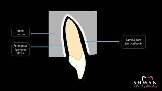 Frontal and undermining resorption [upl. by Ronoh670]