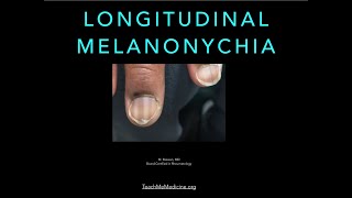 Nails Longitudinal Melanonychia [upl. by Enomad]