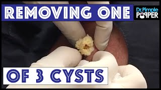 The Bermuda Triangle Cyst excision 1 [upl. by Clein]