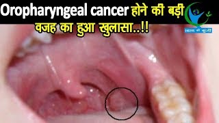 Oropharyngeal Cancer मुख और गले के कैंसर मरीजों के आंकड़ों को सुनकर दंग रह जायेंगे लक्षण और उपचार [upl. by Way]