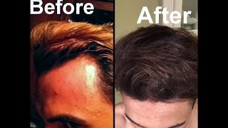 Grow Hair on Receding Hairline Naturally dermaroller and essential oils [upl. by Sil]