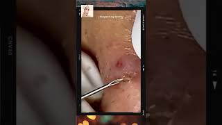 Blackheads Removal  Acne Treatment and Very Satisfying Satisfying Pimple pop blackheads [upl. by Naneik]