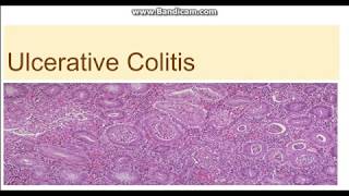 Ulcerative colitis  Morphology Clinical features difference from Crohn disease [upl. by Enidan]