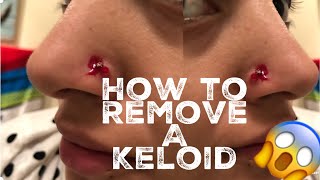 How I Removed My Nose Piercing Bump keloid [upl. by Lesslie974]