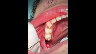 How to pull a broken tooth  First Molar extraction  قلع جراحي [upl. by Howlend]