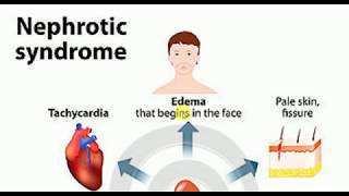 Nephrotic Syndrome  MEDICINE Lectures  NEPHROLOGY  TP 8 [upl. by Butcher]