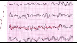 Fibrilación Ventricular vs Torsades de pointes EKG [upl. by Dori]