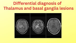 Differential diagnosis of thalamus and basal ganglia lesions [upl. by Alis]