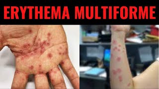 ERYTHEMA MULTIFORME  Triggers Symptoms Diagnosis Treatment  What is Erythema multiforme [upl. by Riffle]