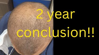 2 year Minoxidil and Finestride update [upl. by Gordan726]