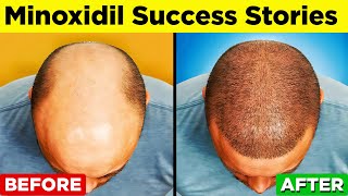 MINOXIDIL  A StepbyStep Guide to Regain Your Hair [upl. by Oinegue486]