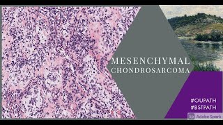 Mesenchymal chondrosarcoma [upl. by Woodie]